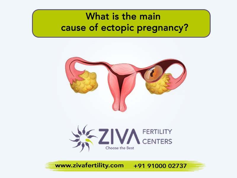 Read more about the article What is the main cause of ectopic pregnancy?