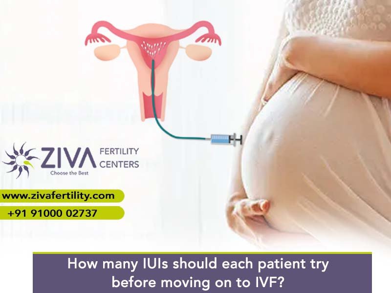 Read more about the article How many IUIs should each couple try before moving on to IVF?