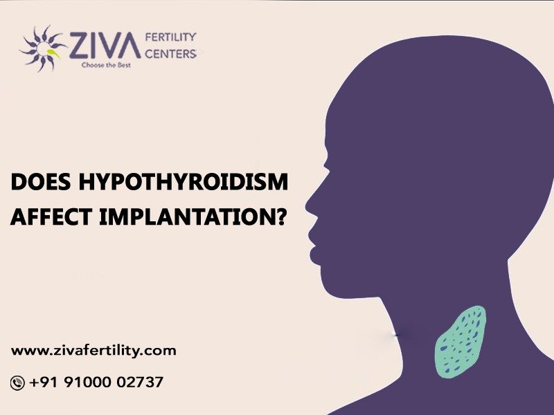 Read more about the article Does hypothyroidism affect implantation