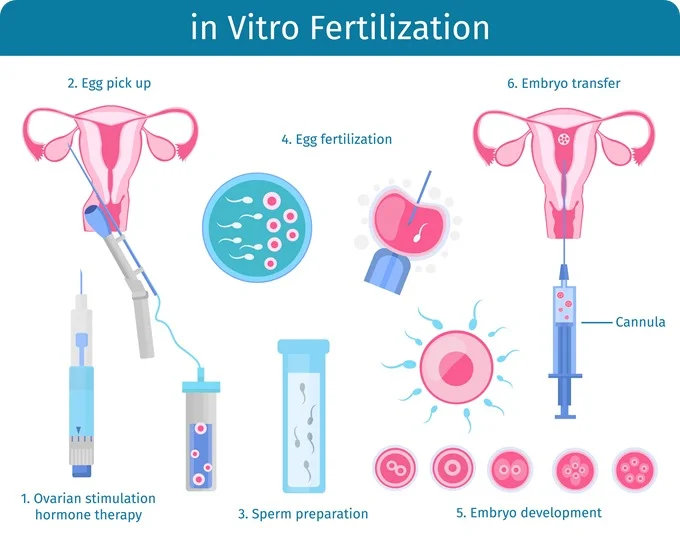 Consult Ziva Fertility Center for successful ivf treatment in Hyderabad, Best fertility clinic near me