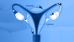 Endometriosis treatment for infertility