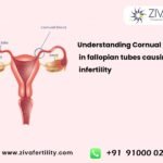 Understanding Cornual block in fallopian tubes causing infertility