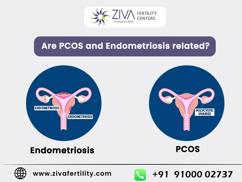 Are PCOS and Endometriosis related