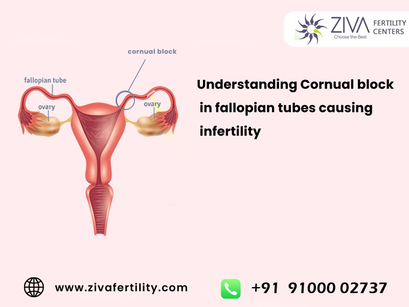 Understanding Cornual block in fallopian tubes causing infertility