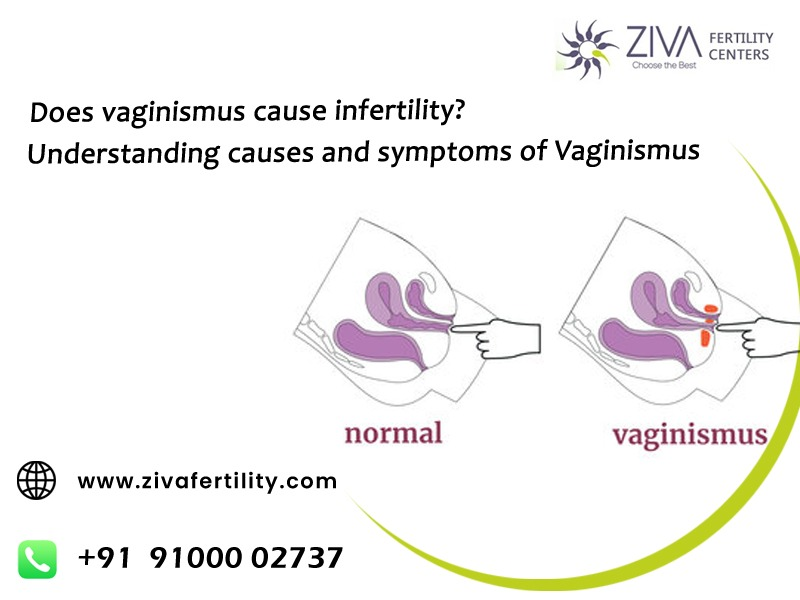 Does vaginismus cause infertility Understanding the causes and symptoms of Vaginismus