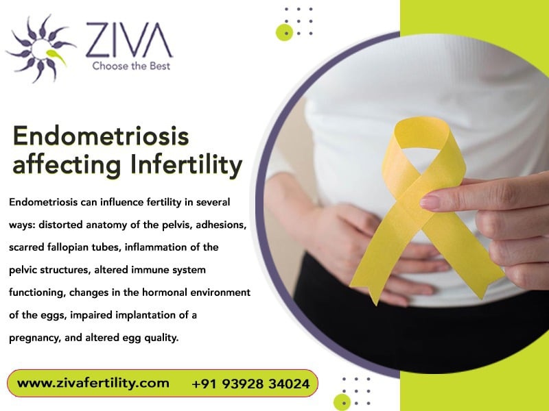 Endometriosis Affecting Infertility: Understanding the Connection