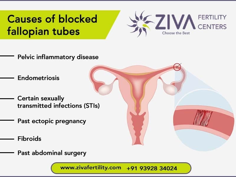 Causes of Blocked Fallopian Tubes: What Every Woman Should Know