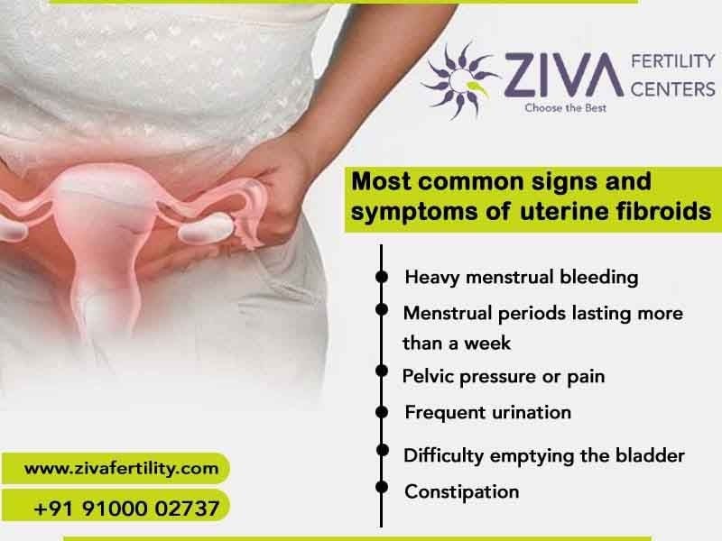 Most Common Signs and Symptoms of Uterine Fibroids: What Every Woman Should Know