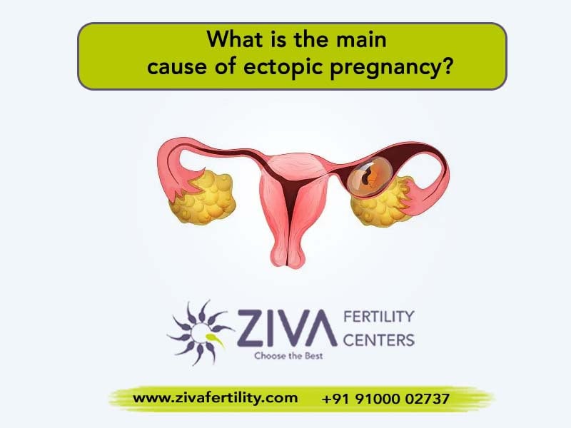 Facts You Must Be Aware of About Ectopic Pregnancy
