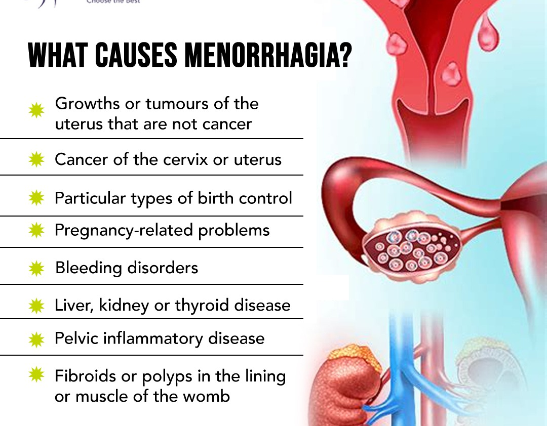 What Causes Menorrhagia?