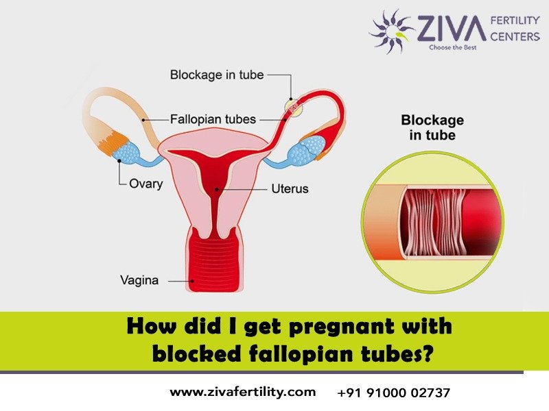 How Did I Get Pregnant With Blocked Fallopian Tubes?