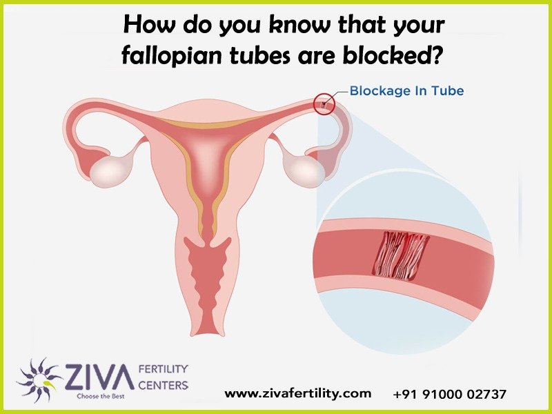 How Do You Know If Your Fallopian Tubes Are Blocked?